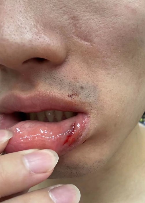 齐麟在社交媒体晒出于德豪嘴唇受伤的照片 看起来有点严重